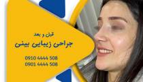 ویدیو جراحی پلاستیک بینی ترمیمی و شکسته