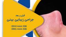 جراحی زیبایی بینی عروسکی