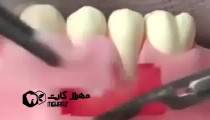 پیوند لثه