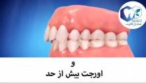 عوارض نامرتبی دندان ها