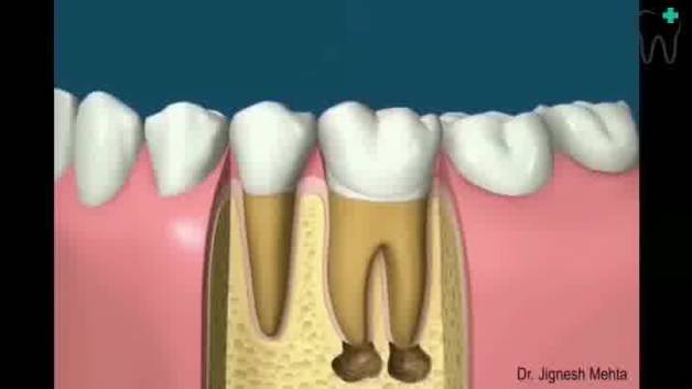 روند درمان ریشه دندان