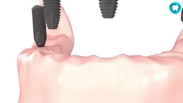نحوه ایمپلنت دندان