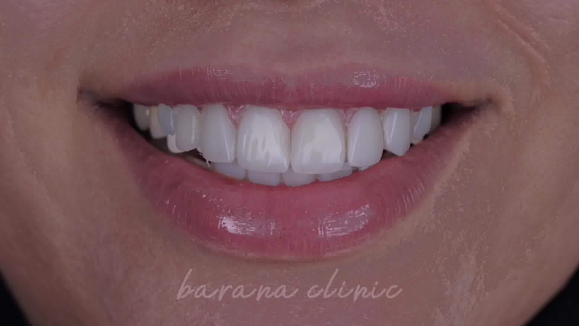 تضمین طرح لبخند شما با ونیر کامپوزیت در کلینیک دندانپزشکی بارانا