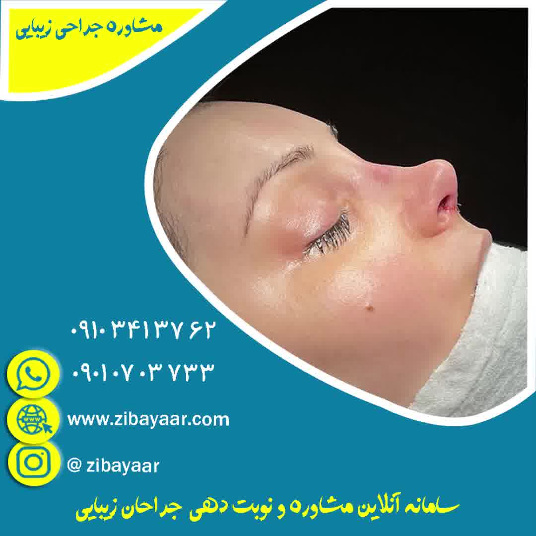 عمل بینی اقساطی در تهران با هزینه مناسب