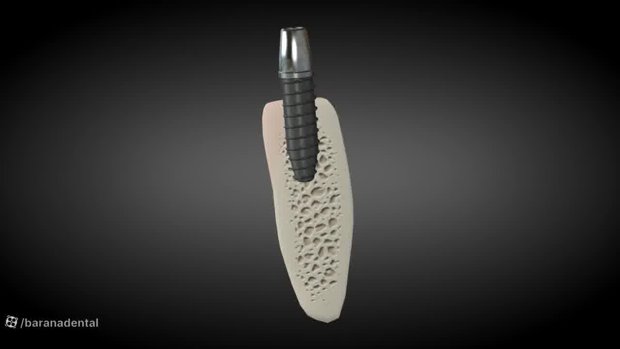 پیوند استخوان فک چگونه انجام می شود؟