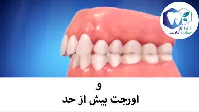 عوارض نامرتبی دندان ها